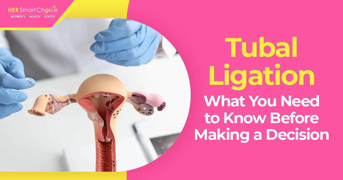 Tubal Ligation birth control