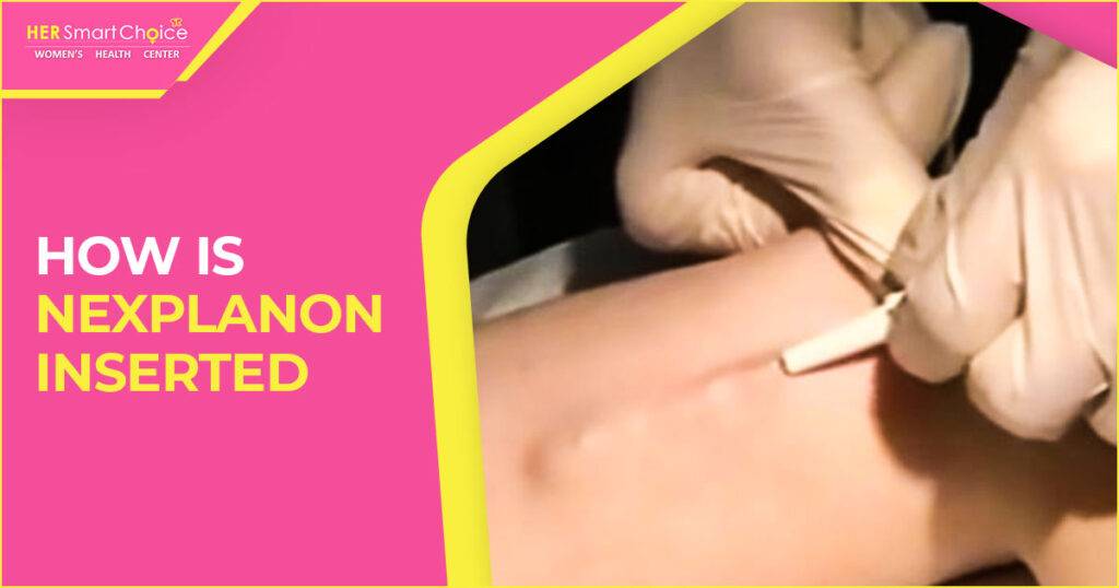 Nexplanon birth control